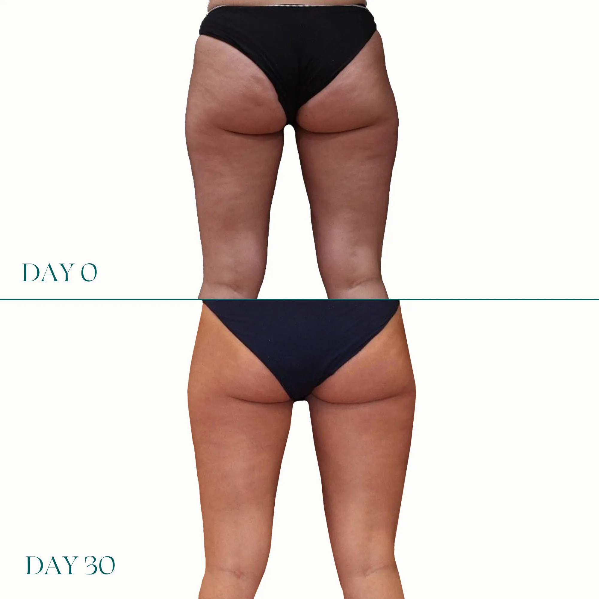 Air-Lite Daily Lift For Legs