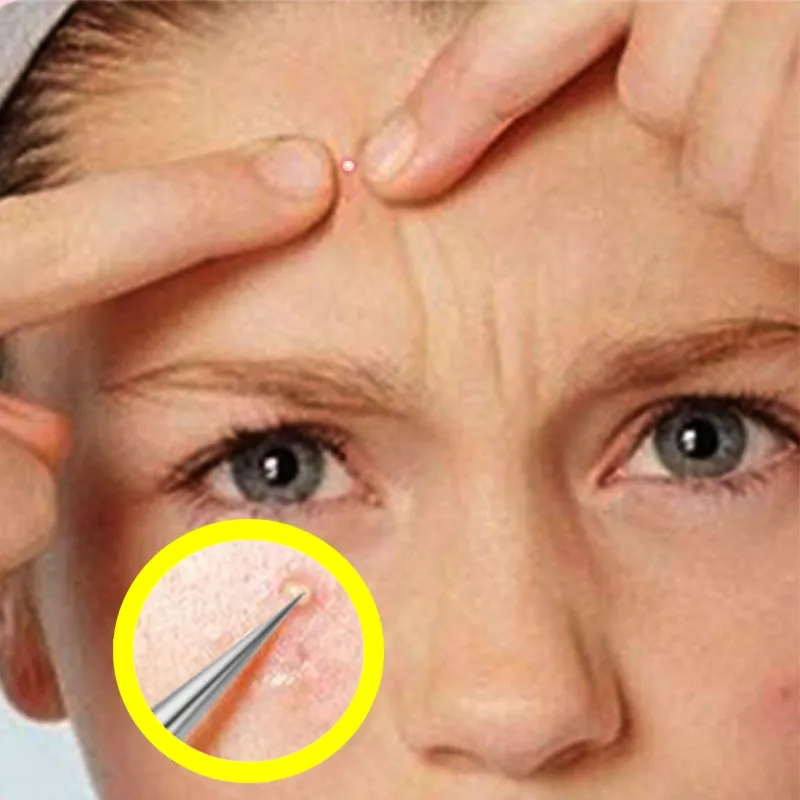 Blackhead acne needle stainless steel dark warehouse needle tool beauty needle
