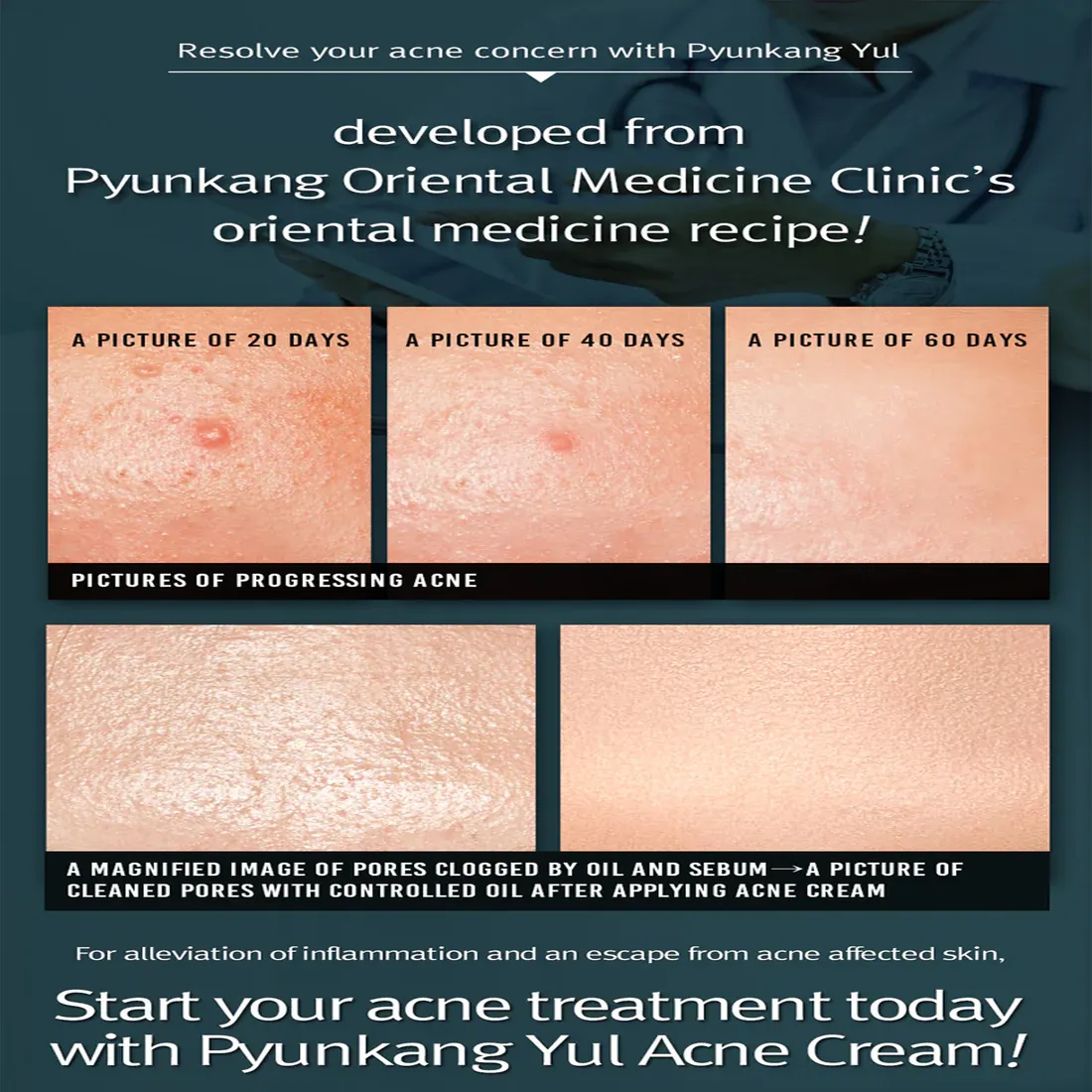 Pyunkang Yul Acne Cream 50ml